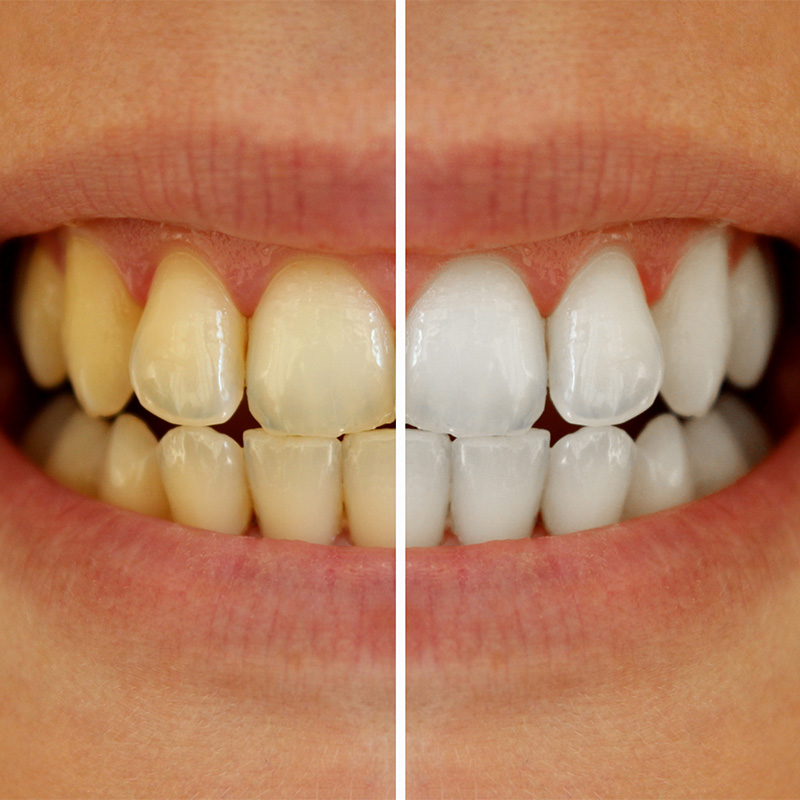 Bleaching eignet sich zur Behandlung einzelner Zähne oder auch der gesamten Zahnreihe. Bleaching eignet sich zur Behandlung einzelner Zähne oder auch der gesamten Zahnreihe.