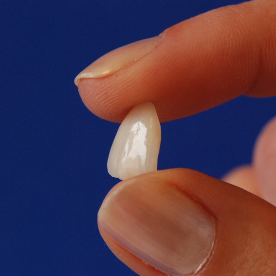 Veneers sind dünne, lichtdurchlässige, keramische Verblendschalen. Veneers sind dünne, lichtdurchlässige, keramische Verblendschalen.