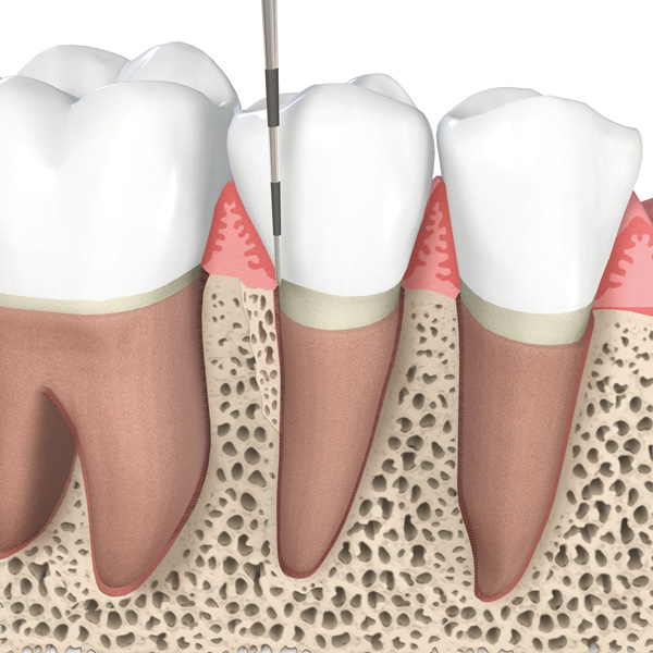 Ursache für eine Parodontitis sind Bakterien, die sich zwischen Zahn und Zahnfleisch ansammeln. Ursache für eine Parodontitis sind Bakterien, die sich zwischen Zahn und Zahnfleisch ansammeln.