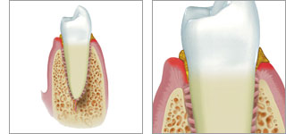 Gingivitis Gingivitis